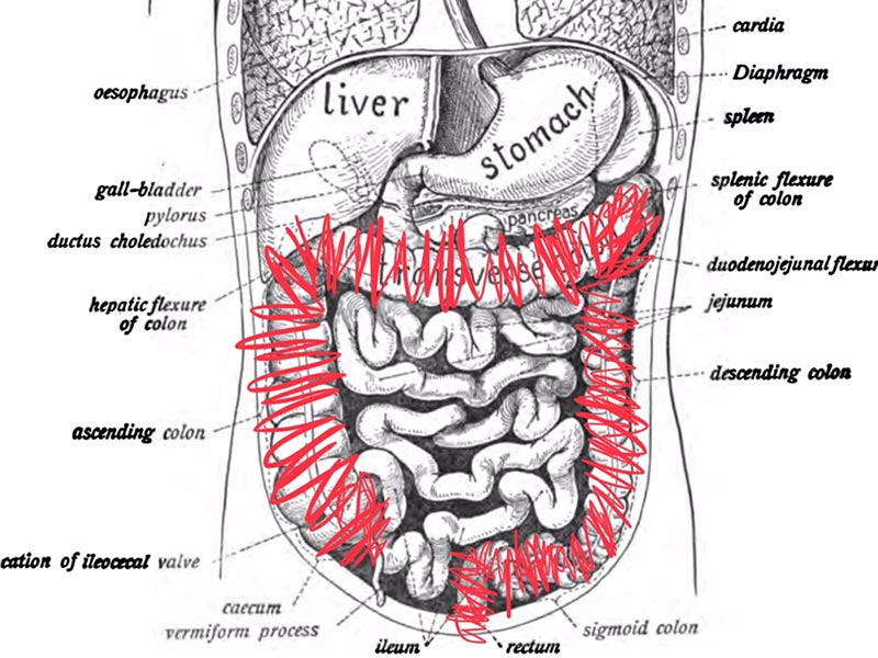 Colectomy diagram - red scribbles over large intestine colon and rectum